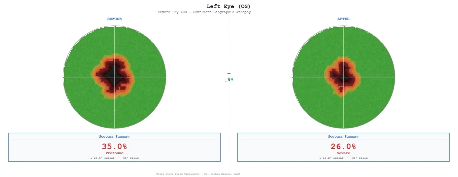 Before — geographic atrophy visual field scan