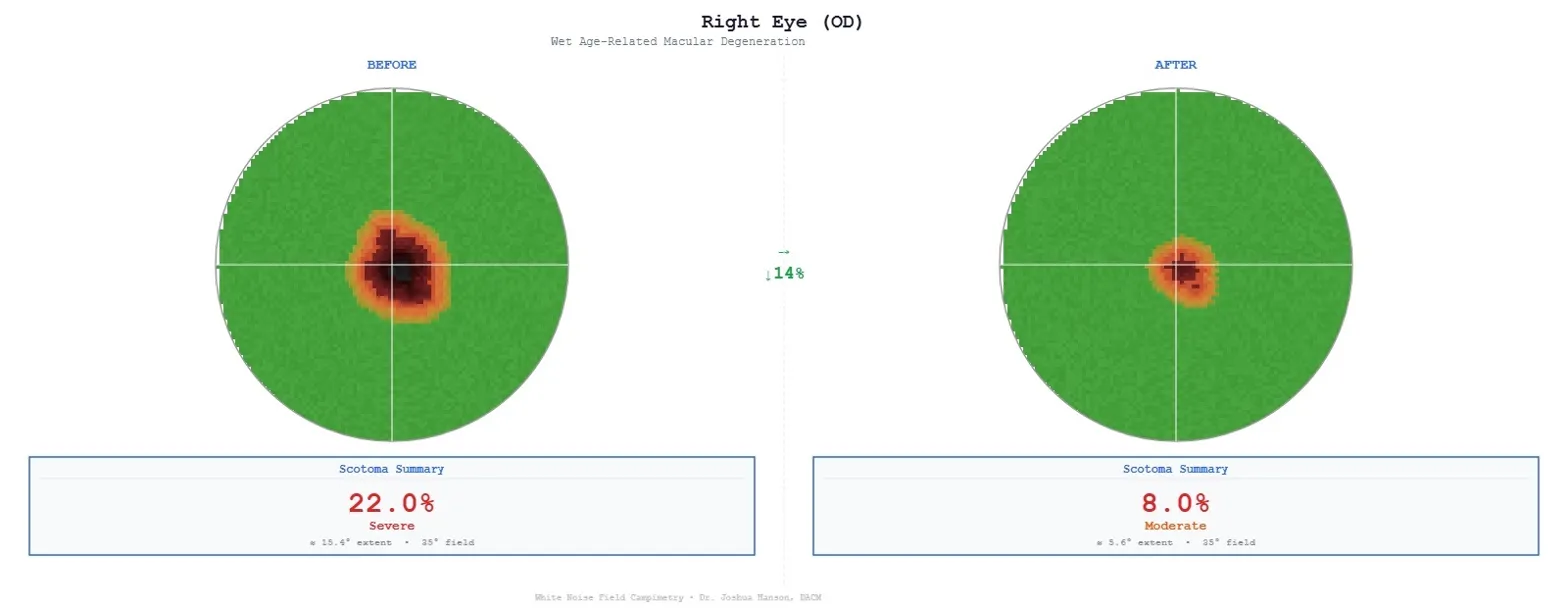 Before — wet AMD visual field scan