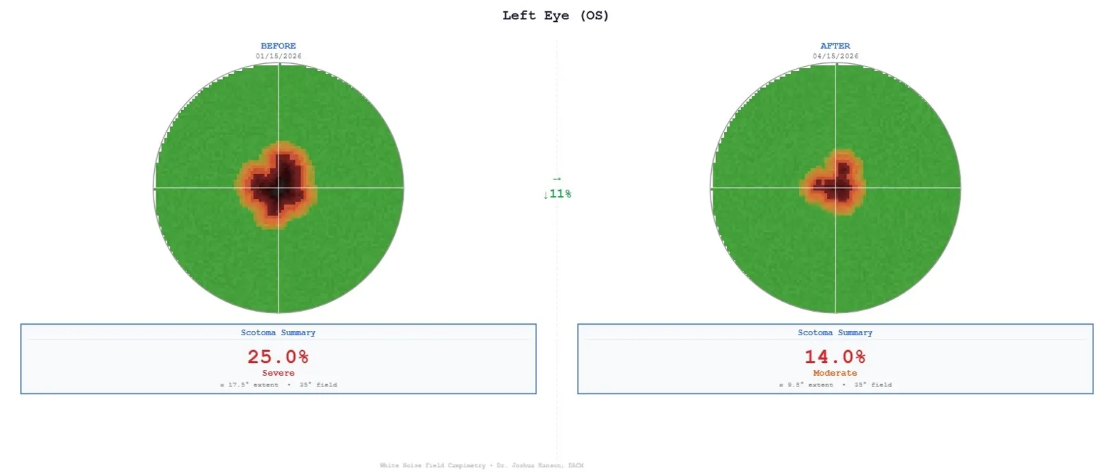 Before — dry AMD visual field scan